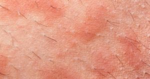 Аллергия после бритья и дерматит