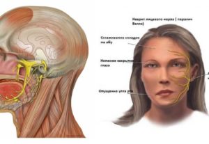 Болит ухо и онемела часть лица