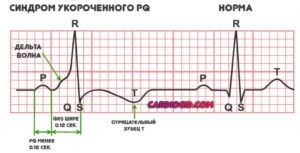 Укорочение интервала pq на экг