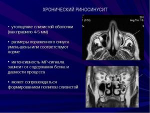 Хронический риносинусит