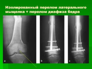 Перелом латерального мыщелка