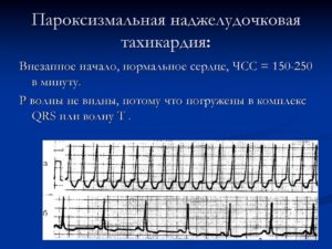 Пароксизмальная тахикардия