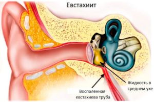 После лечения среднего отита остается заложенность в ухе
