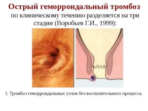Тромбоз геморроидального узла