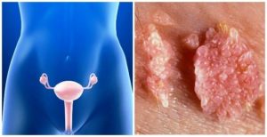 Зуд малых половых губ и входа во влагалище