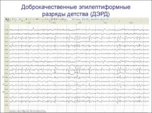 Эпи активность на ЭЭГ ребёнка 3 лет без приступов