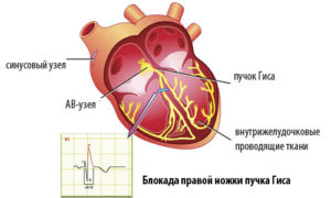Замедление проведения хода возбуждения по правой ножке пучка Гиса