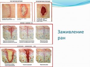 Не заживает рана после операции