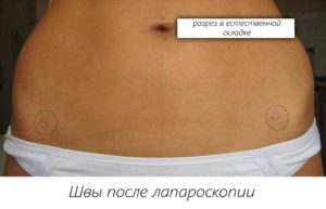 Температура после лапароскопии