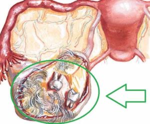Киста яичника у подростка