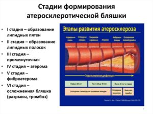 Склеротические изменения стенок МК, АОК.