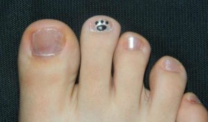 Коричневое пятно на ногте мизинца ноги