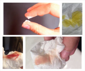 Свечи гексикон при беременности и розовые выделения