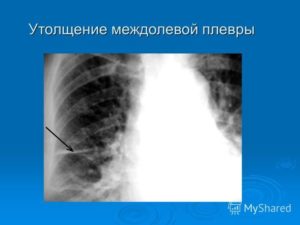 Снижение пневматизации легочной ткани с уплотнением междолевой плевры