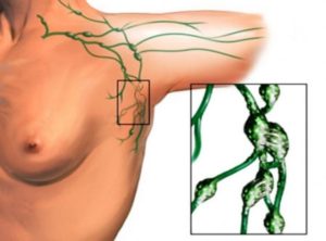 Уплотнение в груди ближе к подмышке