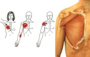 Боль в мышцах лопаток