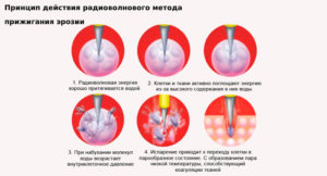 Температура после прижигания эрозии