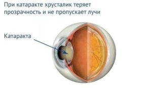 Хрусталик миол-2 при катаракте