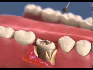 Оголение челюстной кости, удаление зуба