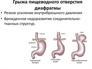Грыжа пищевода, гастроптоз, ГЭРБ, СРК