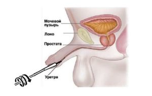 Чем можно заменить мазок (соскоб) при дискомфорте в уретре?