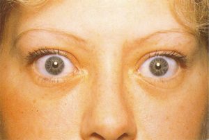 Тиреотоксикоз и глаза