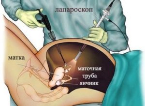 Стимуляция клитора после удаления кисты яичника