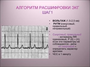 ЭКГ, сердце, расшифровка