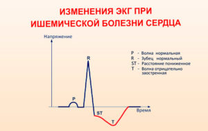 ЭКГ может ли не обнаружить заболевания сердца?