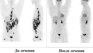 Пэт кт расшифровка