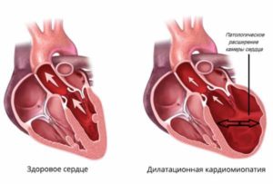 Кардиомегалия плода, кардиомиопатия