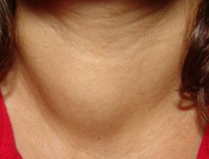 Плотная щитовидная железа