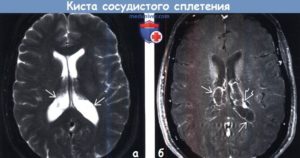 Киста сосудистого сплетения головного мозга