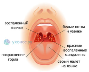 Бугорок на гланде