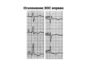 Отклонение ЭОС вправо