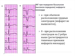 Зачем направляют на ЭКГ после рентгена грудного отдела