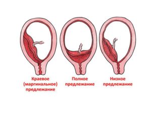 Низкое прикрепление хориона и выделения