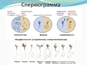 Агглютинации спермиев помогает ли андродоз для зачатия?