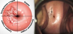 Образование на шейке матки ввиде прыщика