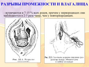 Разрыв влагалища
