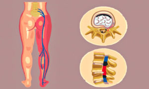 Межпозвоночная грыжа, боли в ноге