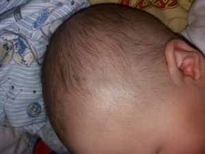 Что делать с шишкой на лбу у младенца с рождения?