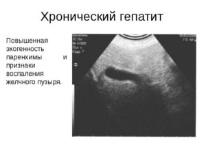 Стенки желчных протоков повышенной эхогенности