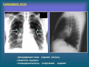 Корни легких с полицикличными контурами