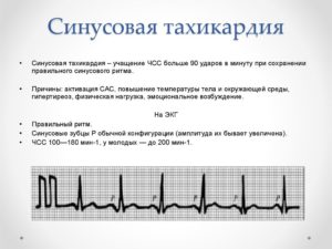 Синусовая тахикардия, высокое давление