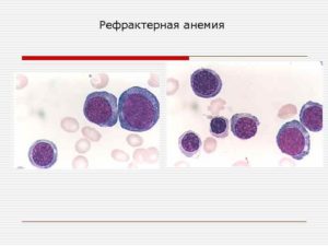 Рефрактерная анемия