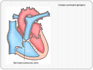 Стеноз легочной артерии