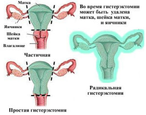 Возможность беременности после удаления матки