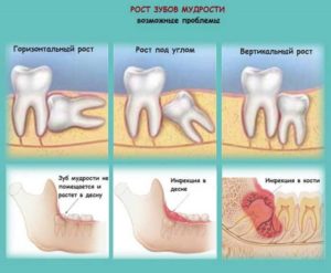 Зуб мудрости растет в нёбо