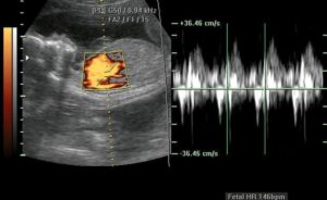 Сердцебиение у эмбриона